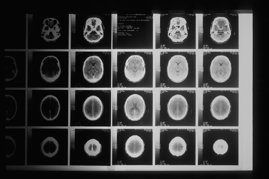CT scan images display cross-sectional views of a human brain in grayscale, arranged in a grid of five columns and four rows, illuminated against a dark background.